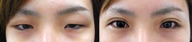 挙筋短縮による眼瞼下垂症例写真
