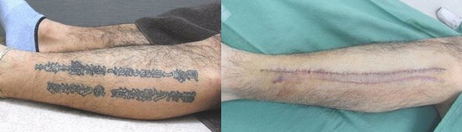 左ふくらはぎ、レタリングタトゥーの除去症例２