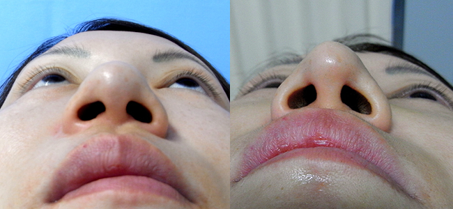 プロテーゼ隆鼻術 + 耳介軟骨(メッシュボール)移植鼻尖形成術　症例１