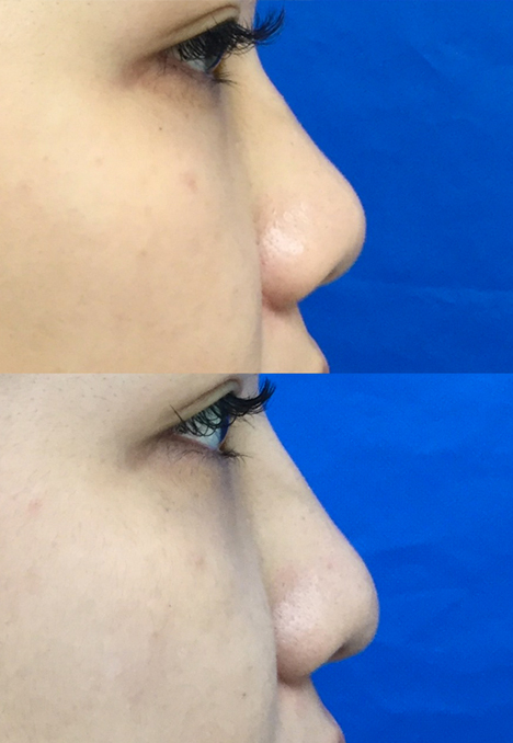 耳介軟骨(メッシュボール)移植鼻尖形成術症例