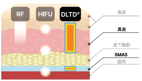 HIFUやRFとの違い