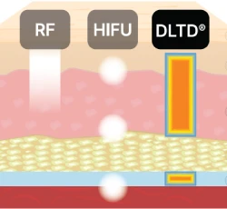 HIFUとRFを同時に行う