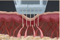 従来のニードルRF