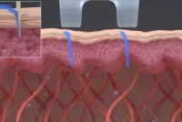 従来のニードルRF