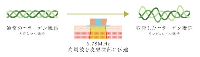 RF（高周波）