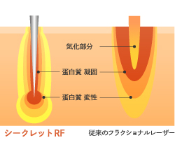 シークレットRFと従来品のレーザー照射比較図