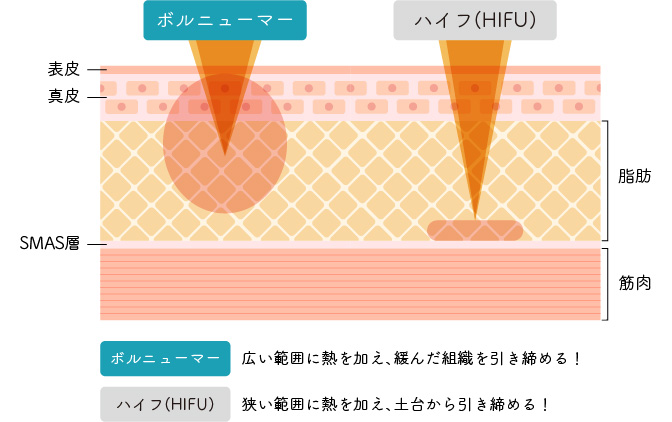 ボルニューマーとハイフ(HIFU)の違い