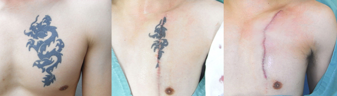 左胸、はがき約3枚分タトゥーの除去症例１