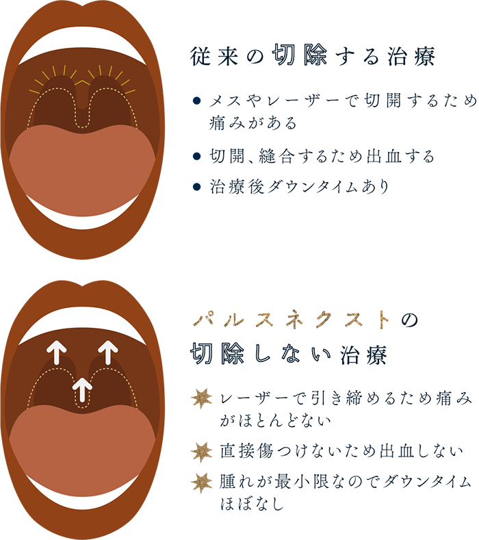 従来の切除する治療…メスやレーザーで切開するため痛みがある 切開、縫合するため出血する 治療後ダウンタイムあり パルスネクストの切除しない治療...レーザーで引き締めるため痛みがほとんどない 直接傷つけないため出血しない 腫れが最小限なのでダウンタイムほぼなし