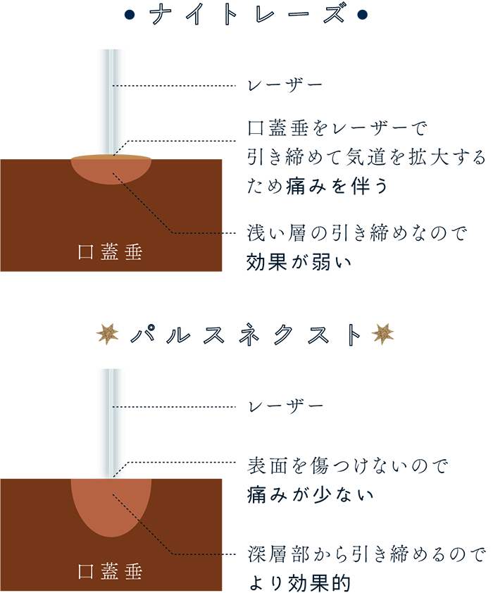 ナイトレーズ…口蓋垂をレーザーで引き締めて気道を拡大するため痛みを伴う パルスネクスト...表面を傷つけないので痛みが少ない 深層部から引き締めるのでより効果的